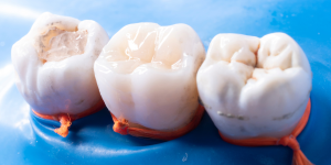 How Long Does a Tooth Filling Last